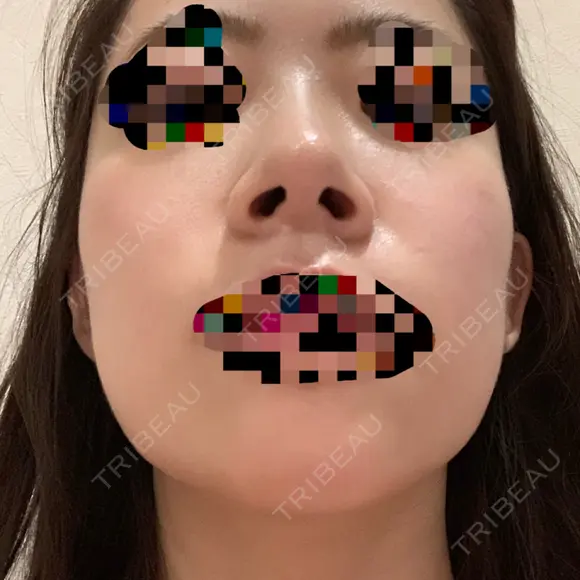 小鼻縮小（切開） / スレッドノーズ / 鼻尖縮小 / ヒアルロン酸注入（鼻） キップン整形外科 DAY 17 メイン用