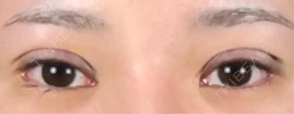 二重埋没 / ボトックス（眉間） / ボトックス（額） 藤・ナチュレ美容クリニック 銀座院 DAY 0 メイン用