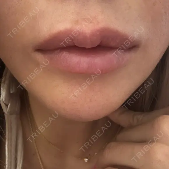 ヒアルロン酸注入（唇） HAAB BEAUTY CLINIC 名古屋院 AFTER メイン用