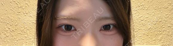 二重埋没 / 目頭切開 / 上まぶたの脂肪取り / ヒアルロン酸注入（涙袋） アリエル美容クリニック 郡山院 AFTER メイン用
