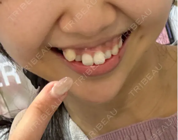ボトックス（口角） veary clinic DAY 26 メイン用