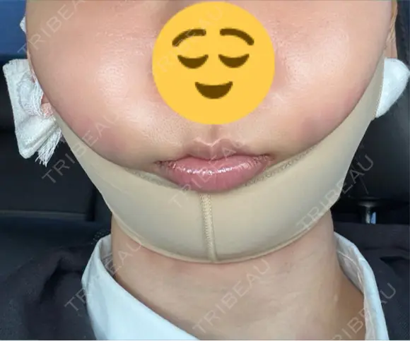 脂肪吸引（顔） / ジョールファット除去 / ボトックス（あご） / ヒアルロン酸注入（あご） / ボトックス（首） WOM CLINIC GINZA （ワム クリニック ギンザ） DAY 0 メイン用
