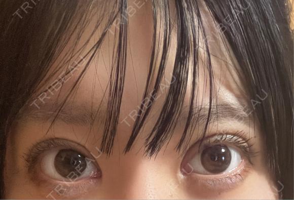 二重埋没 アリエル美容クリニック 郡山院 DAY 9 メイン用