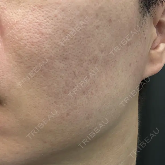 肌育注射（ジュベルックなど） / ニードルRF（ポテンツァなど） PureMe Skin Clinic（ピュアミースキンクリニック麻布） DAY 37 メイン用