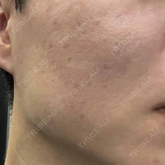 肌育注射（ジュベルックなど） / ニードルRF（ポテンツァなど） PureMe Skin Clinic（ピュアミースキンクリニック麻布） DAY 37 メイン用