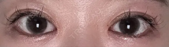 二重埋没 / 目頭切開 / 自然癒着法 Stand by Beauty Clinic AFTER メイン用