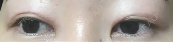 二重切開 表参道スキンクリニック 表参道院 AFTER メイン用