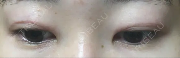 二重切開 表参道スキンクリニック 表参道院 DAY 131 メイン用