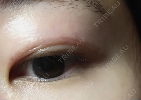 二重切開 表参道スキンクリニック 表参道院 DAY 131 メイン用