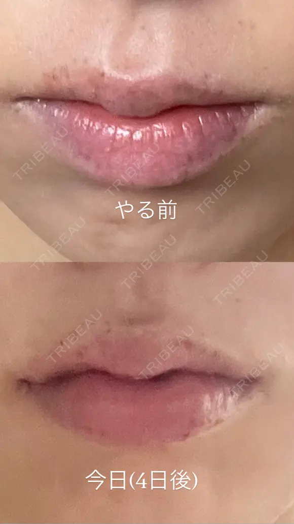 ヒアルロン酸注入（唇） PRO CLINIC プロクリニック 銀座院 AFTER メイン用
