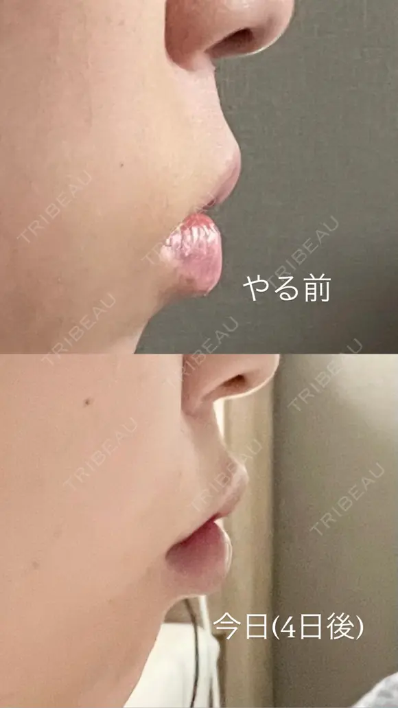 ヒアルロン酸注入（唇） PRO CLINIC プロクリニック 銀座院 DAY 4 メイン用