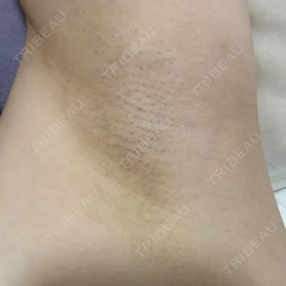 医療脱毛（ワキ） ルラ美容クリニック 渋谷本院 DAY 0 メイン用