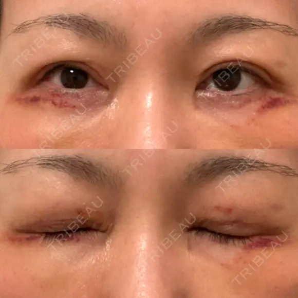 二重切開 / 眼瞼下垂（切開） / 目元修正 湘南美容クリニック 神戸三宮院 DAY 10 メイン用