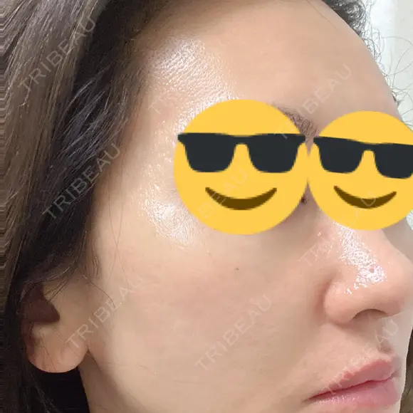 ピーリング（ハリ・ツヤ） HAAB CLINIC 池袋院 DAY 1 メイン用