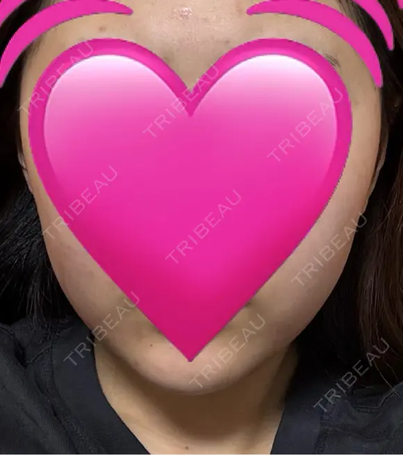 インモード ARTE BEAUTY CLINIC DAY 0 メイン用