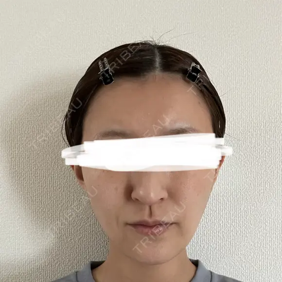 脂肪注入（額） / ボトックス（あご） / ヒアルロン酸注入（唇） / 脂肪注入（輪郭） アリエル美容クリニック 大宮院 DAY 88 メイン用