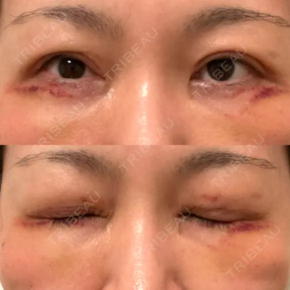 二重切開 / 眼瞼下垂（切開） / 目元修正 湘南美容クリニック 神戸三宮院 DAY 11 メイン用