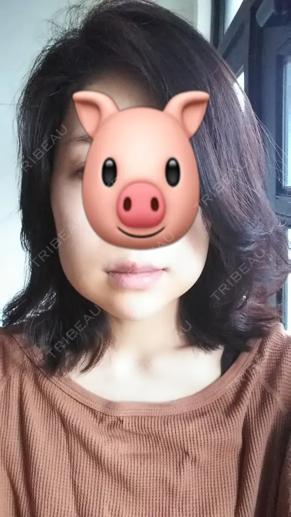 ハイフ（顔） CLASSY 仙台美容外科・美容皮膚科 DAY 2 メイン用