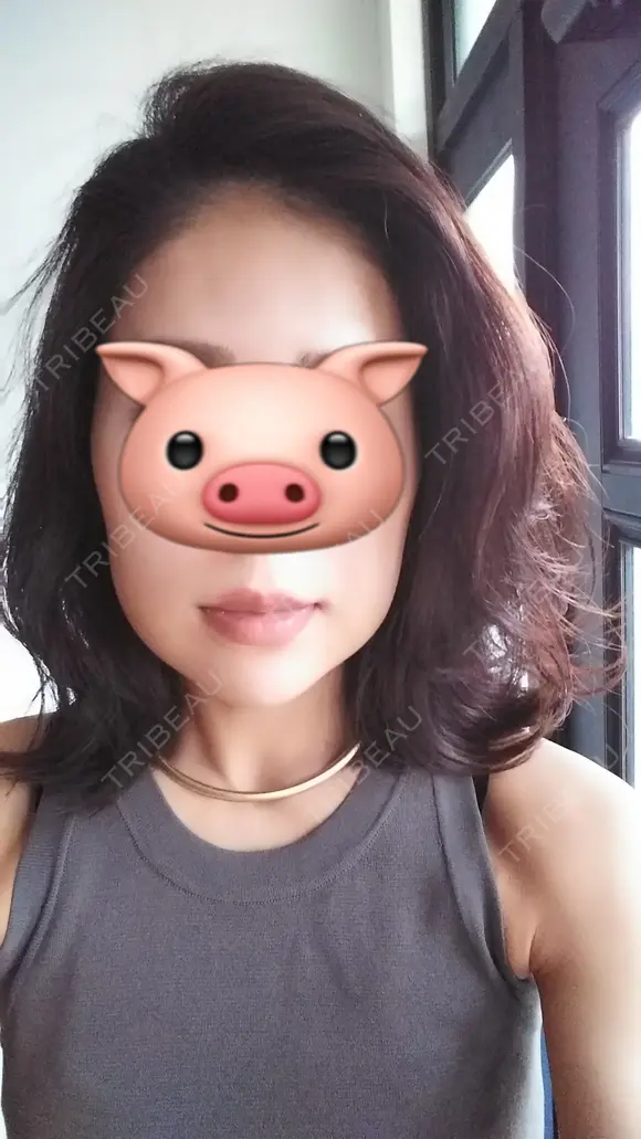 ハイフ（顔） CLASSY 仙台美容外科・美容皮膚科 DAY 4 メイン用