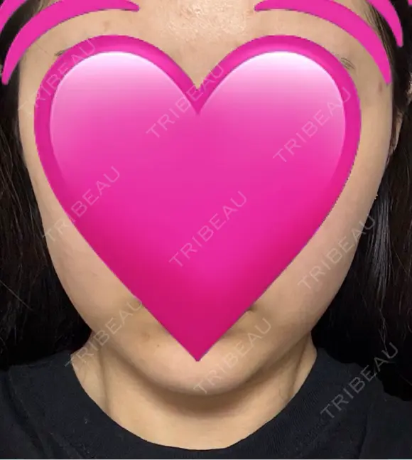 インモード ARTE BEAUTY CLINIC AFTER メイン用