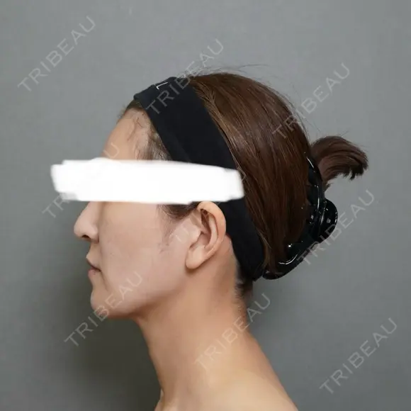 脂肪注入（額） / ボトックス（あご） / ヒアルロン酸注入（唇） / 脂肪注入（輪郭） アリエル美容クリニック 大宮院 DAY 95 メイン用