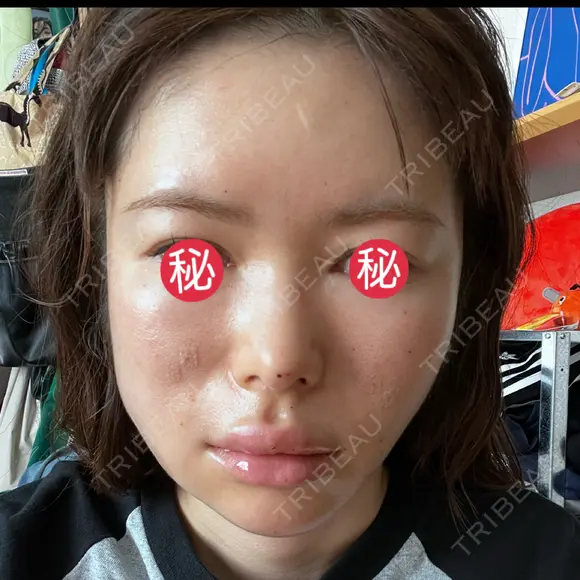 糸リフト / ボトックス（あご） / ヒアルロン酸注入（あご） / ボトックス（エラ・小顔） / ヒアルロン酸注入（唇） / ボトックス（口角） / ヒアルロン酸注入（額） / ヒアルロン酸注入（頬） / ヒアルロン酸注入（目の下） / ボトックス（眉間） / ボトックス（額） / ボトックス（人中） / ヒアルロン酸注入（鼻翼基部） EMMO FACE CLINIC 大宮院 DAY 1 メイン用
