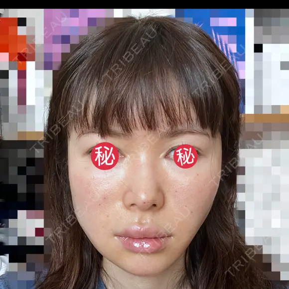 糸リフト / ボトックス（あご） / ヒアルロン酸注入（あご） / ボトックス（エラ・小顔） / ヒアルロン酸注入（唇） / ボトックス（口角） / ヒアルロン酸注入（額） / ヒアルロン酸注入（頬） / ヒアルロン酸注入（目の下） / ボトックス（眉間） / ボトックス（額） / ボトックス（人中） / ヒアルロン酸注入（鼻翼基部） EMMO FACE CLINIC 大宮院 DAY 2 メイン用