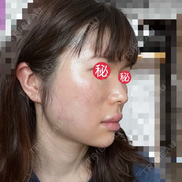 糸リフト / ボトックス（あご） / ヒアルロン酸注入（あご） / ボトックス（エラ・小顔） / ヒアルロン酸注入（唇） / ボトックス（口角） / ヒアルロン酸注入（額） / ヒアルロン酸注入（頬） / ヒアルロン酸注入（目の下） / ボトックス（眉間） / ボトックス（額） / ボトックス（人中） / ヒアルロン酸注入（鼻翼基部） EMMO FACE CLINIC 大宮院 DAY 2 メイン用