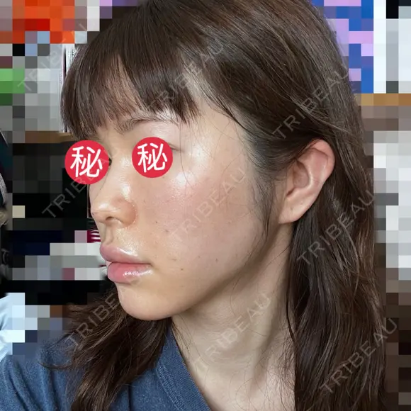 糸リフト / ボトックス（あご） / ヒアルロン酸注入（あご） / ボトックス（エラ・小顔） / ヒアルロン酸注入（唇） / ボトックス（口角） / ヒアルロン酸注入（額） / ヒアルロン酸注入（頬） / ヒアルロン酸注入（目の下） / ボトックス（眉間） / ボトックス（額） / ボトックス（人中） / ヒアルロン酸注入（鼻翼基部） EMMO FACE CLINIC 大宮院 DAY 2 メイン用