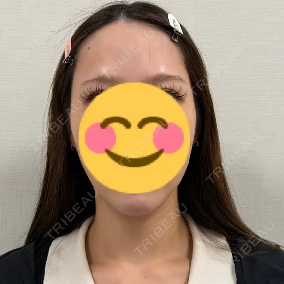 ヒアルロン酸注入（頬） ライブリークリニック 船橋院 AFTER メイン用