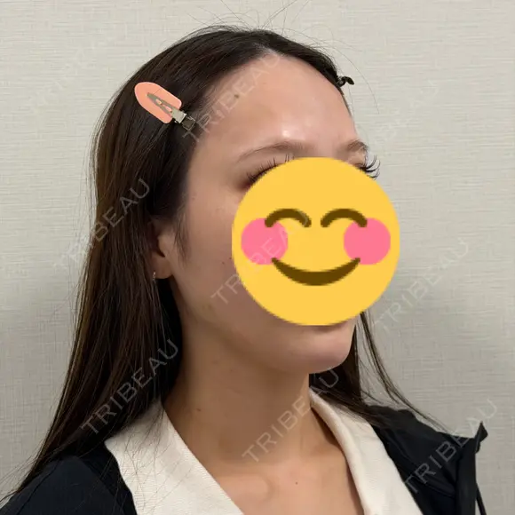 ヒアルロン酸注入（頬） ライブリークリニック 船橋院 DAY 0 メイン用