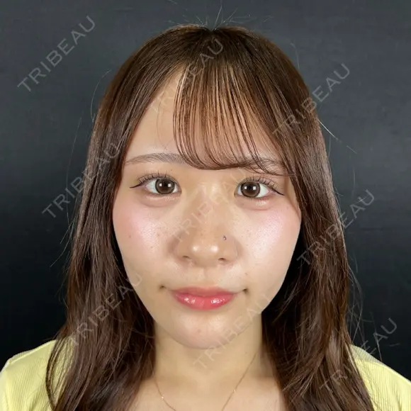 二重埋没 / ほくろ・いぼ切除（肌） / 上まぶたの脂肪取り / タレ目形成・グラマラスライン（切開） / 目元修正 / ボトックス（眉間） 藤・ナチュレ美容クリニック 銀座院 AFTER メイン用