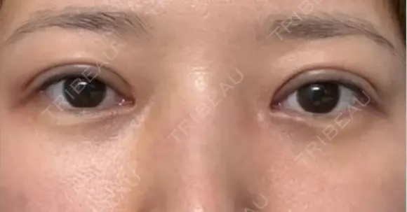 眼瞼下垂（切開） / 下まぶたたるみ取り WOM CLINIC GINZA （ワム クリニック ギンザ） DAY 31 メイン用