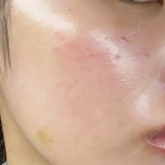 肌育注射（ジュベルックなど） / イオン導入 / 光治療（フォトフェイシャルなど） / ルメッカ Belle Via Clinic DAY 5 メイン用