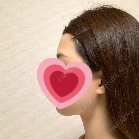 脂肪吸引（顔） R Beauty CLINIC 銀座院 AFTER メイン用