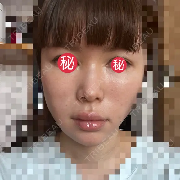 糸リフト / ボトックス（あご） / ヒアルロン酸注入（あご） / ボトックス（エラ・小顔） / ヒアルロン酸注入（唇） / ボトックス（口角） / ヒアルロン酸注入（額） / ヒアルロン酸注入（頬） / ヒアルロン酸注入（目の下） / ボトックス（眉間） / ボトックス（額） / ボトックス（人中） / ヒアルロン酸注入（鼻翼基部） EMMO FACE CLINIC 大宮院 DAY 3 メイン用