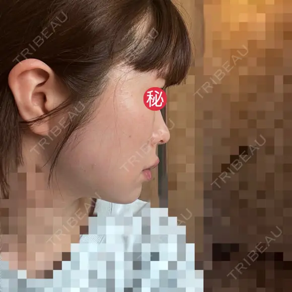 糸リフト / ボトックス（あご） / ヒアルロン酸注入（あご） / ボトックス（エラ・小顔） / ヒアルロン酸注入（唇） / ボトックス（口角） / ヒアルロン酸注入（額） / ヒアルロン酸注入（頬） / ヒアルロン酸注入（目の下） / ボトックス（眉間） / ボトックス（額） / ボトックス（人中） / ヒアルロン酸注入（鼻翼基部） EMMO FACE CLINIC 大宮院 DAY 3 メイン用