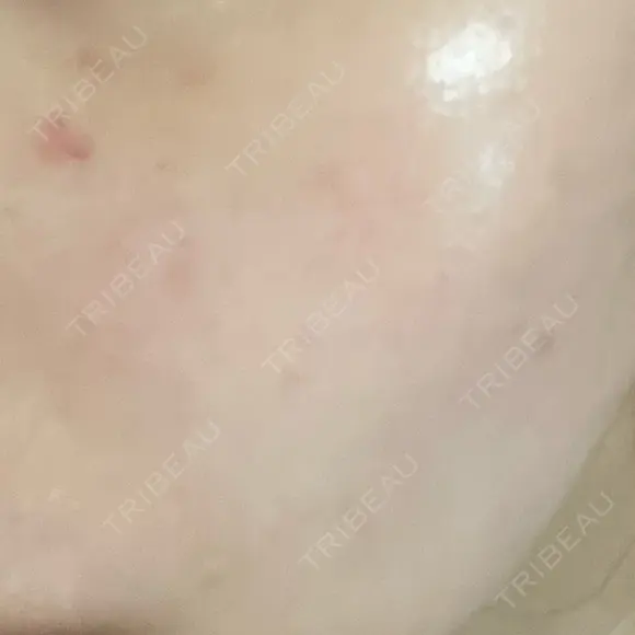 肌育注射（ジュベルックなど） / イオン導入 / 光治療（フォトフェイシャルなど） / ルメッカ Belle Via Clinic DAY 8 メイン用