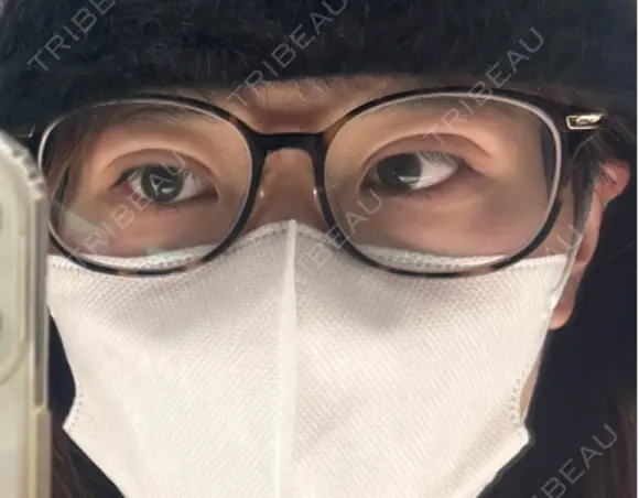 二重埋没 ルラ美容クリニック 仙台院 / ルラスキンクリニック 仙台院 DAY 0 メイン用
