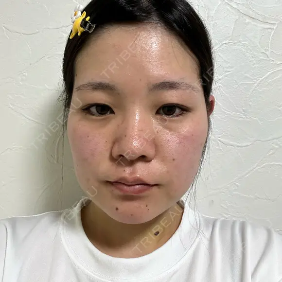 糸リフト / バッカルファット除去 / 脂肪吸引（顔） / ボトックス（口角） / ボトックス（首） アリエル美容クリニック 水戸院 DAY 21 メイン用