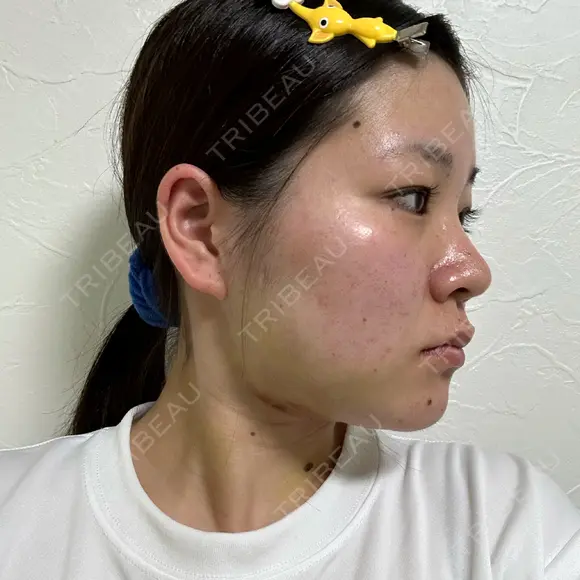 糸リフト / バッカルファット除去 / 脂肪吸引（顔） / ボトックス（口角） / ボトックス（首） アリエル美容クリニック 水戸院 DAY 21 メイン用