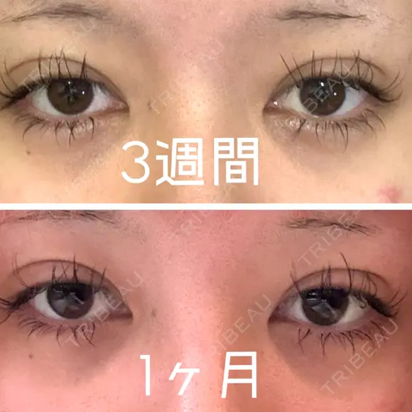 二重埋没 共立美容外科 立川院 DAY 34 メイン用