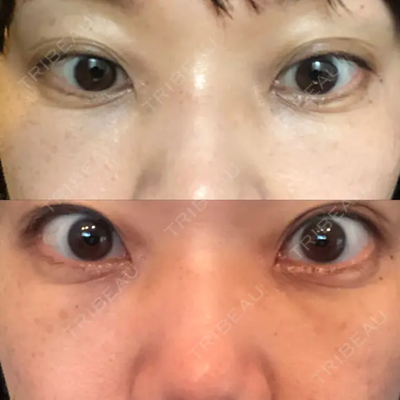 下まぶたたるみ取り セオリークリニック AFTER メイン用