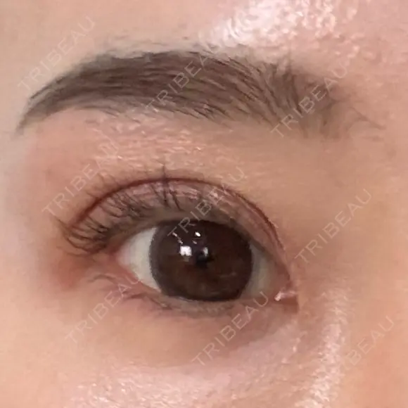 タレ目形成・グラマラスライン（埋没） Olino美容外科・美容皮膚科 DAY 8 メイン用