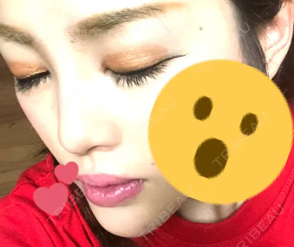 ヒアルロン酸注入（鼻） / ヒアルロン酸注入（頬） 銀座国際美容外科 池袋院 DAY 0 メイン用