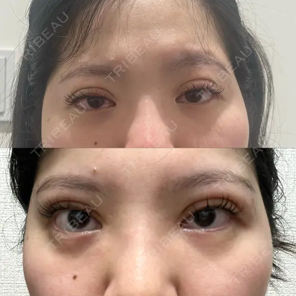 二重埋没 HAAB×DREAM BEAUTY CLINIC 大阪梅田院 AFTER メイン用