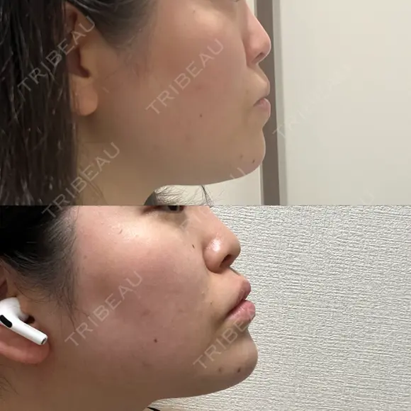 二重埋没 HAAB×DREAM BEAUTY CLINIC 大阪梅田院 DAY 4 メイン用