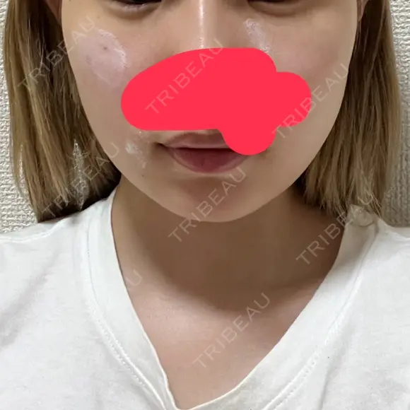 糸リフト / 脂肪吸引（顔） / ボトックス（エラ・小顔） PRISM Beauty Clinic 町田院 DAY 22 メイン用