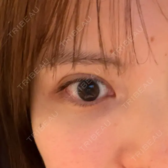 二重埋没 水の森美容クリニック 横浜院 DAY 4 メイン用