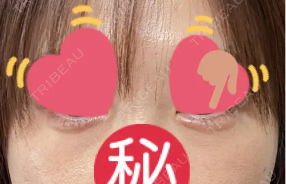 ヒアルロン酸注入（涙袋） PRO CLINIC プロクリニック 銀座院 DAY 17 メイン用
